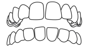 Invisalign-Best-Orthodontist-in-India-Bengal-Kolkata-Dentotsav-Dental-Clinic