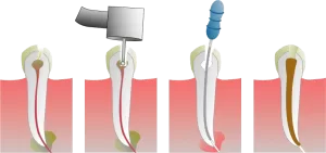 ROOT CANAL PROCEDURE_BEST RCT IN KOLKATA_DENTOTSAV